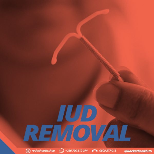 IUD REMOVAL 1