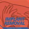 Implant-Removal-(Gynaecologist)