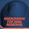 INGROWING TOE NOIL REMOVAL