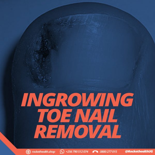 INGROWING TOE NOIL REMOVAL