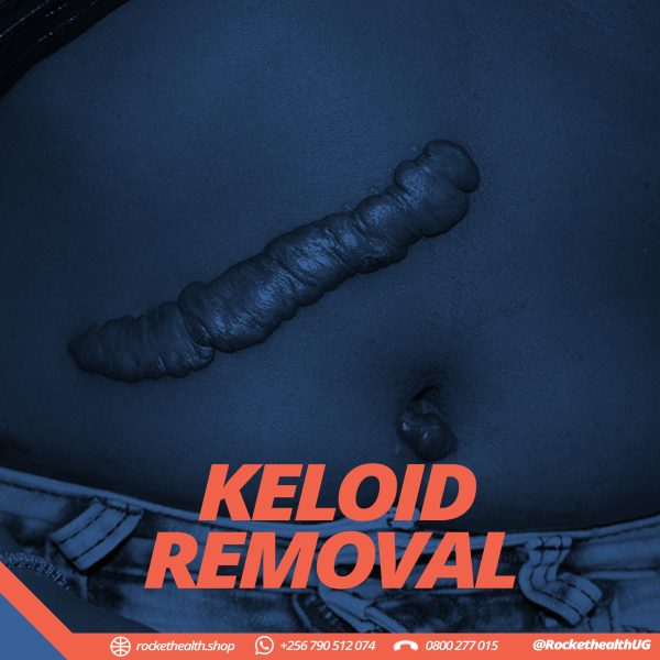 KELOID REMOVAL